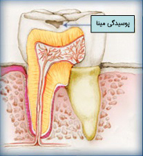 tooth decay